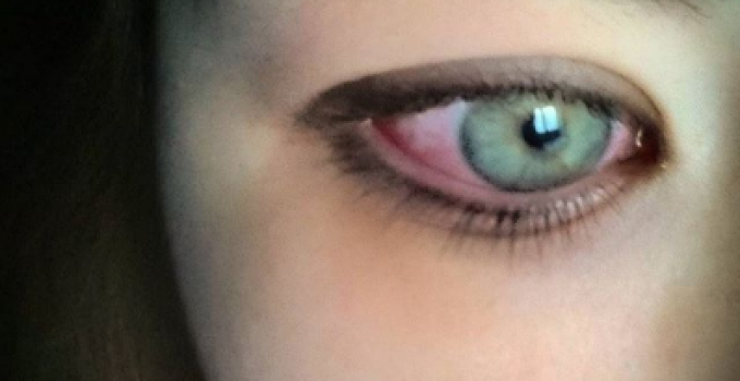 Porque Duelen Las Bolas Debajo Del Ojo