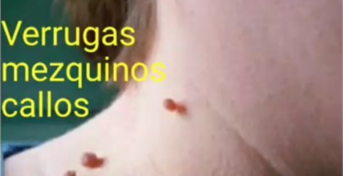 Porque Duelen Las Verrugas En El Cuello