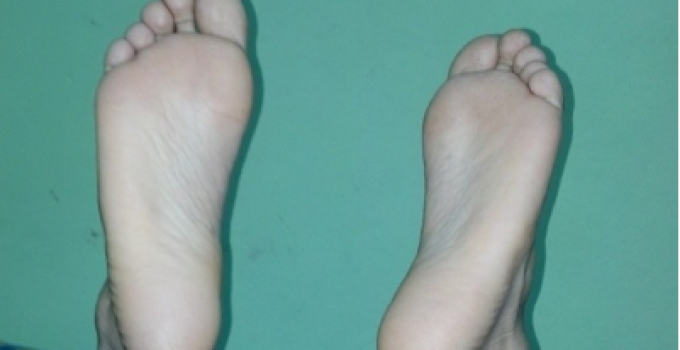 ¿Por qué duelen las plantas de los pies?
