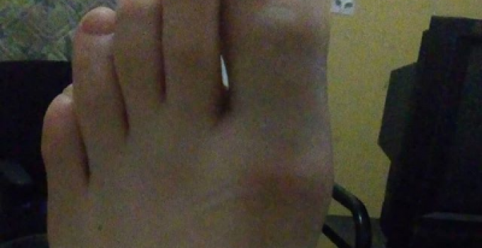 Porque Siento Dolor En La Punta del Dedo Gordo del Pie