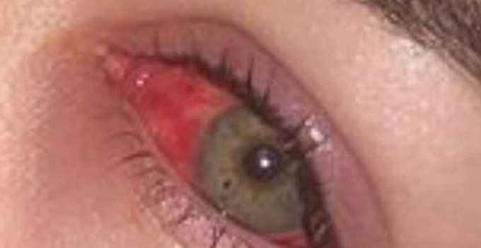 porque se revientan las venas en los ojos